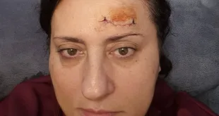„НЯМА ДА МЪЛЧА“: Разбиха главата на зам.-шефка на Общинския съвет в дискотека в Плевен